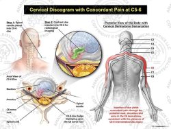 Male Right Cervical Discogram with Concordant Pain at C5-6
