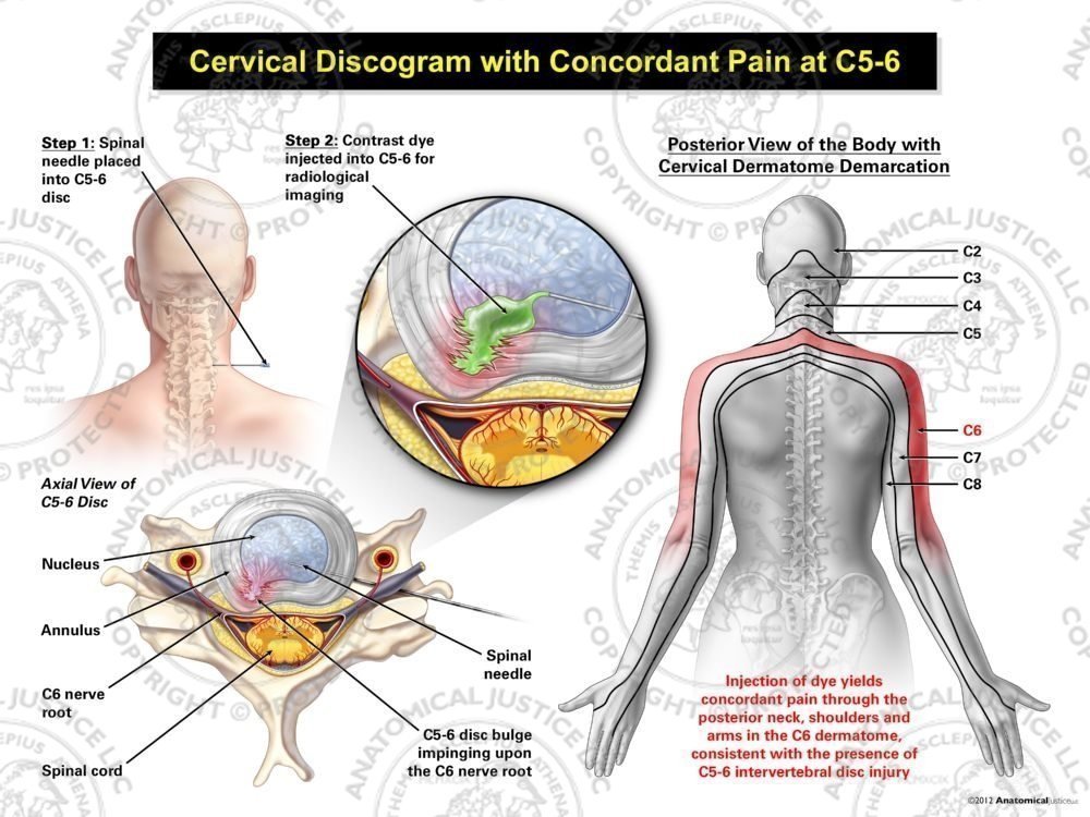 Female Right Cervical Discogram with Concordant Pain at C5-6