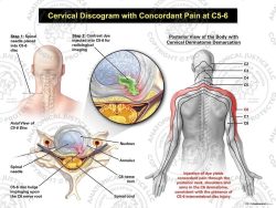 Male Left Cervical Discogram with Concordant Pain at C5-6