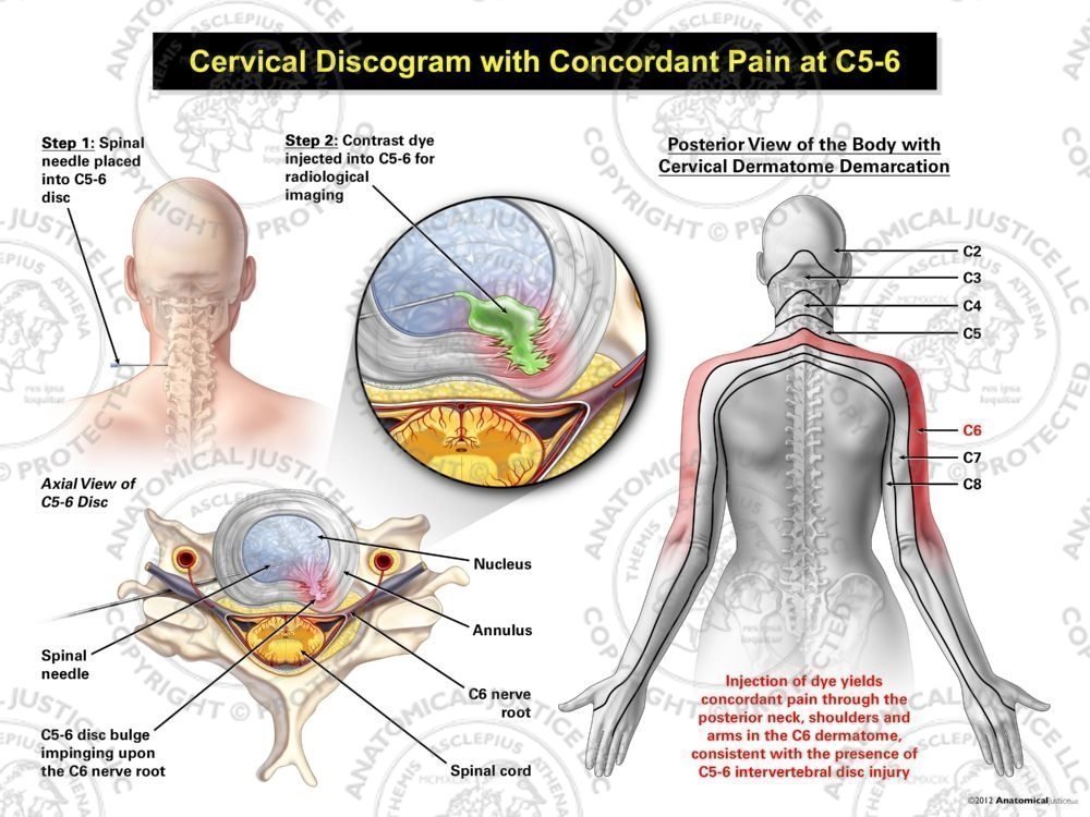 Female Left Cervical Discogram with Concordant Pain at C5-6
