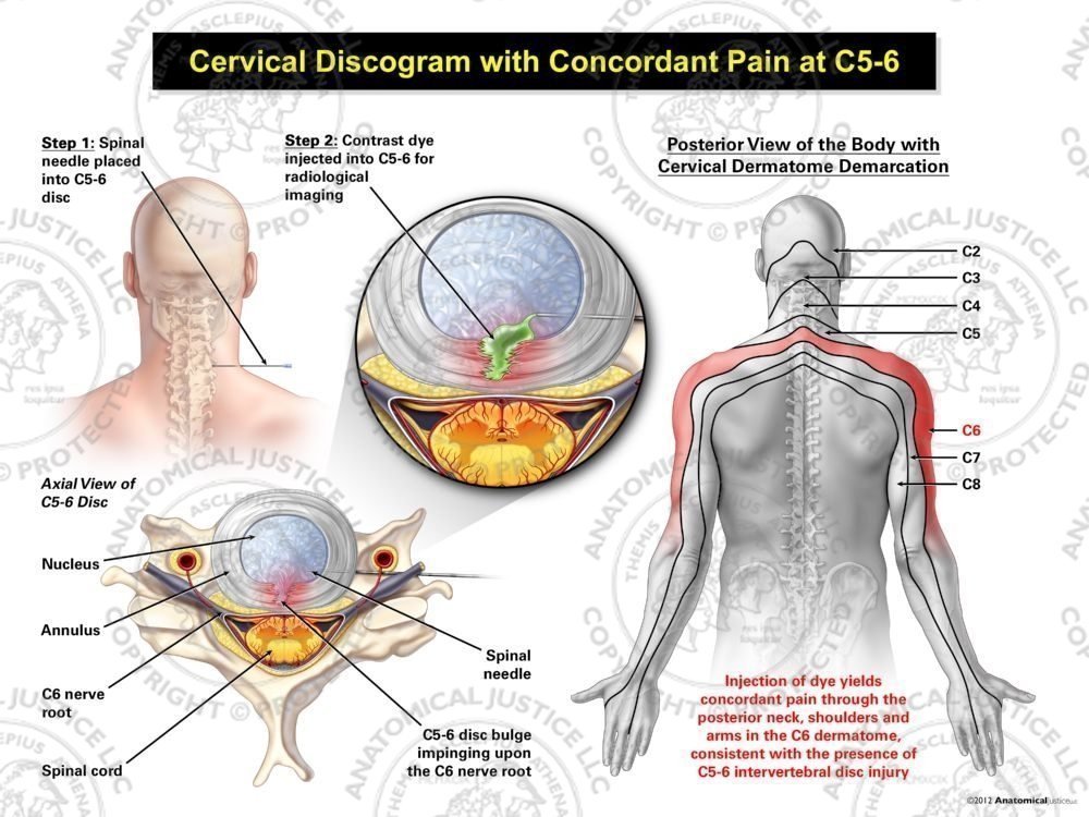 Male Central Cervical Discogram with Concordant Pain at C5-6