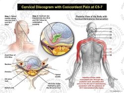 Male Right Cervical Discogram with Concordant Pain at C5-7