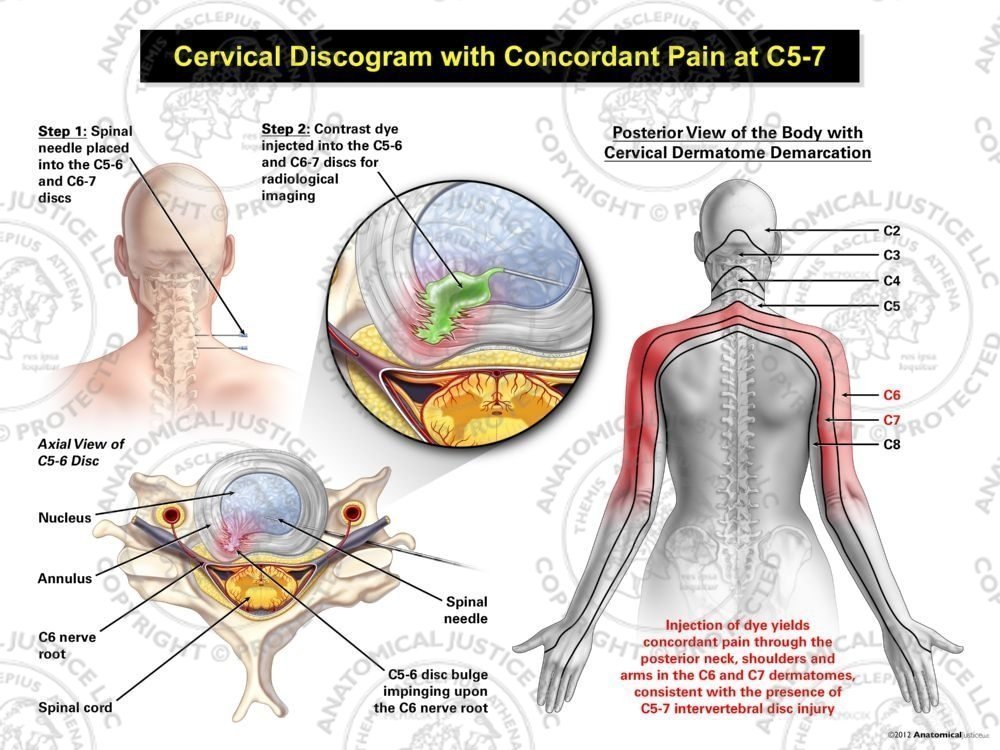 Female Right Cervical Discogram with Concordant Pain at C5-7
