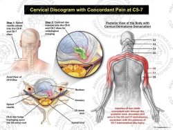 Male Left Cervical Discogram with Concordant Pain at C5-7