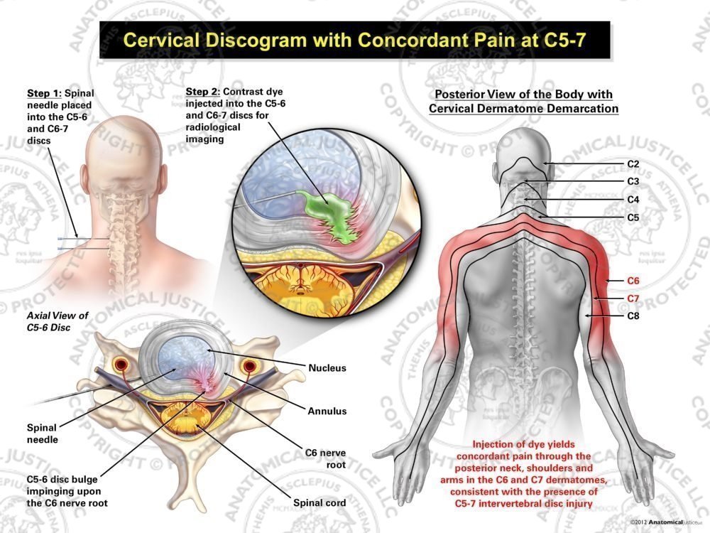 Male Left Cervical Discogram with Concordant Pain at C5-7