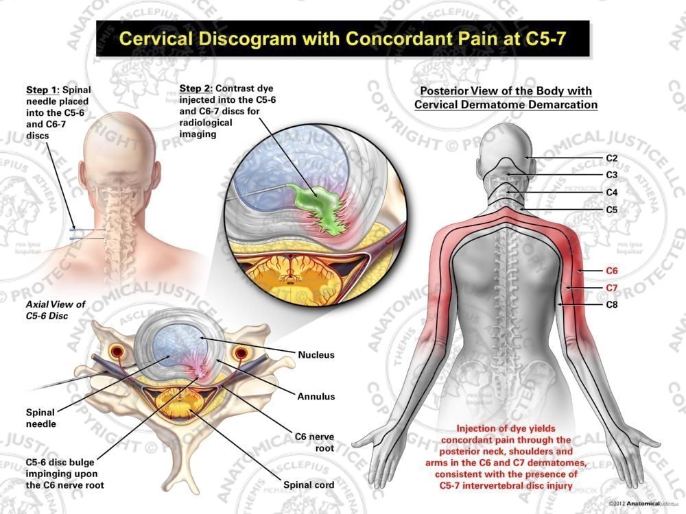 Female Left Cervical Discogram with Concordant Pain at C5-7
