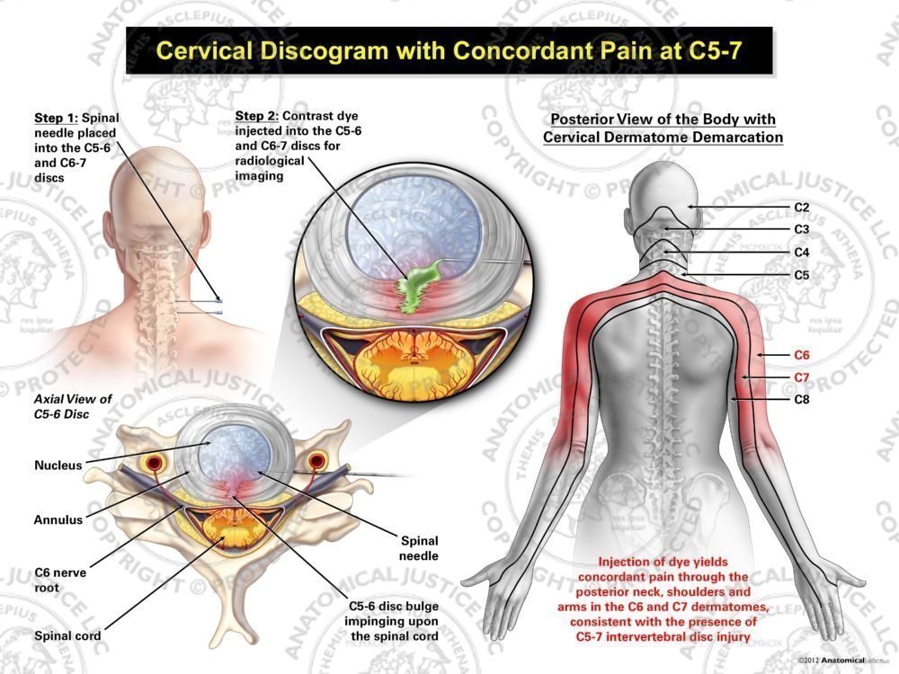 Female Central Cervical Discogram with Concordant Pain at C5-7