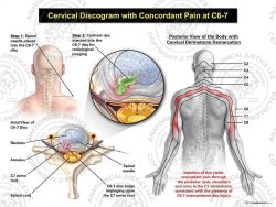 Male Right Cervical Discogram with Concordant Pain at C6-7