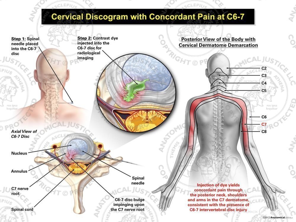 Female Right Cervical Discogram with Concordant Pain at C6-7
