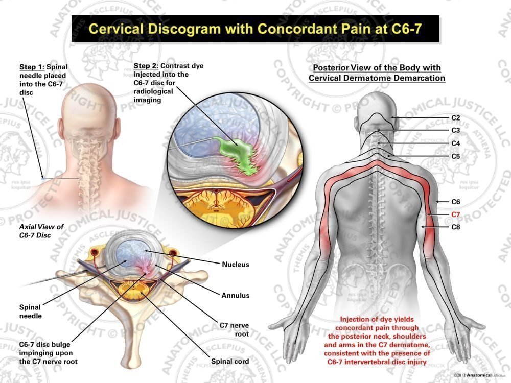 Male Left Cervical Discogram with Concordant Pain at C6-7