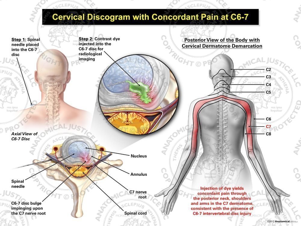 Female Left Cervical Discogram with Concordant Pain at C6-7
