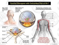 Female Central Cervical Discogram with Concordant Pain at C6-7