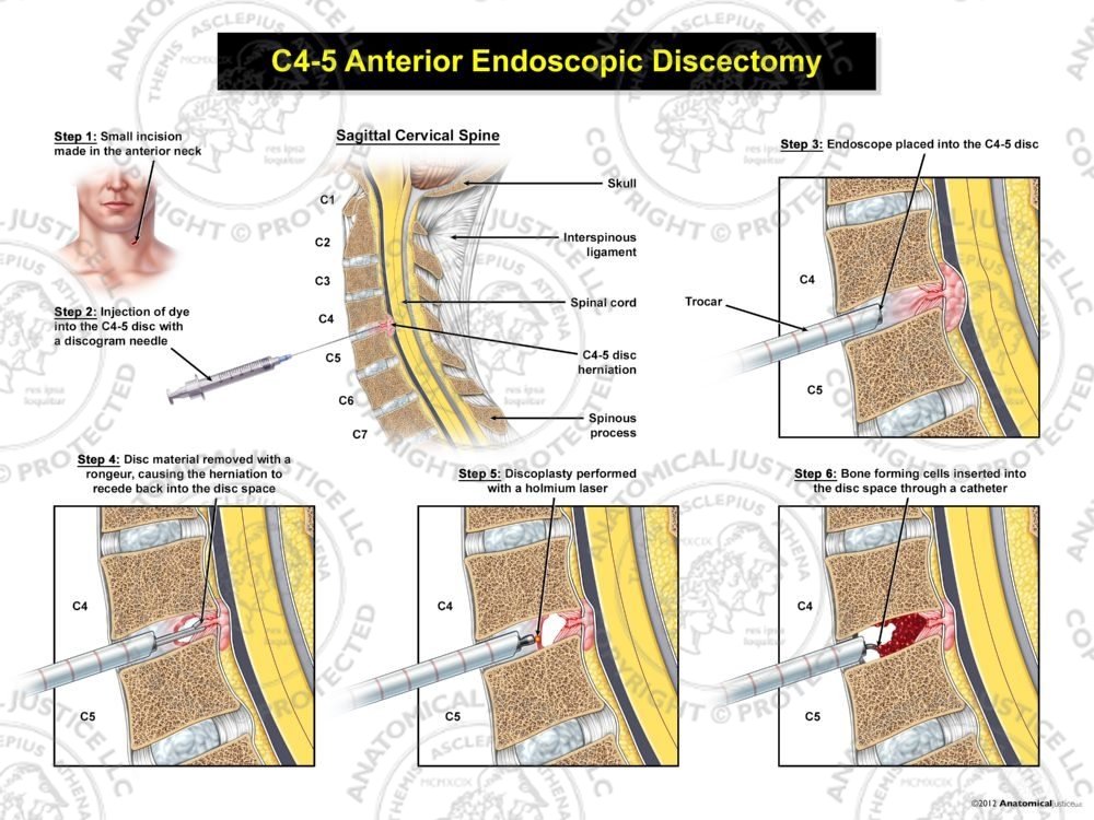 C4-5 Endoscopic Discectomy