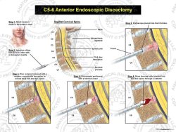 C5-6 Endoscopic Discectomy