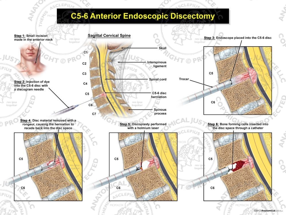C5-6 Endoscopic Discectomy