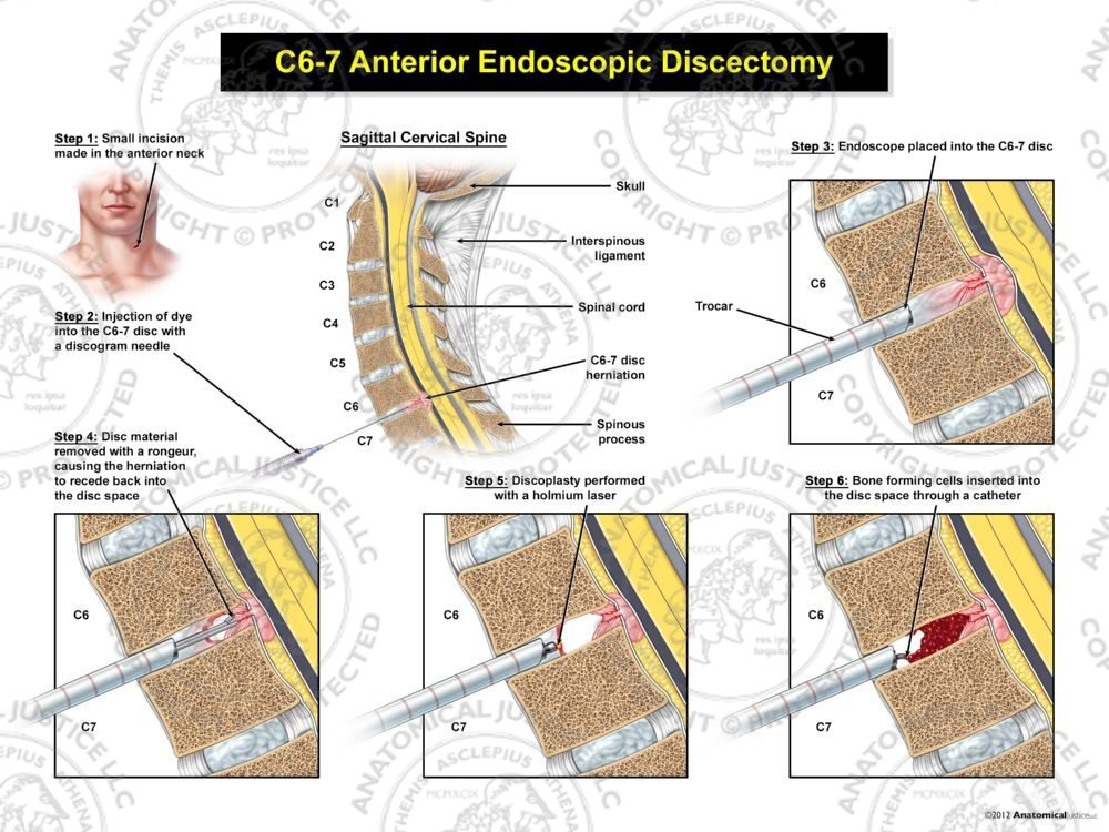 C6-7 Endoscopic Discectomy