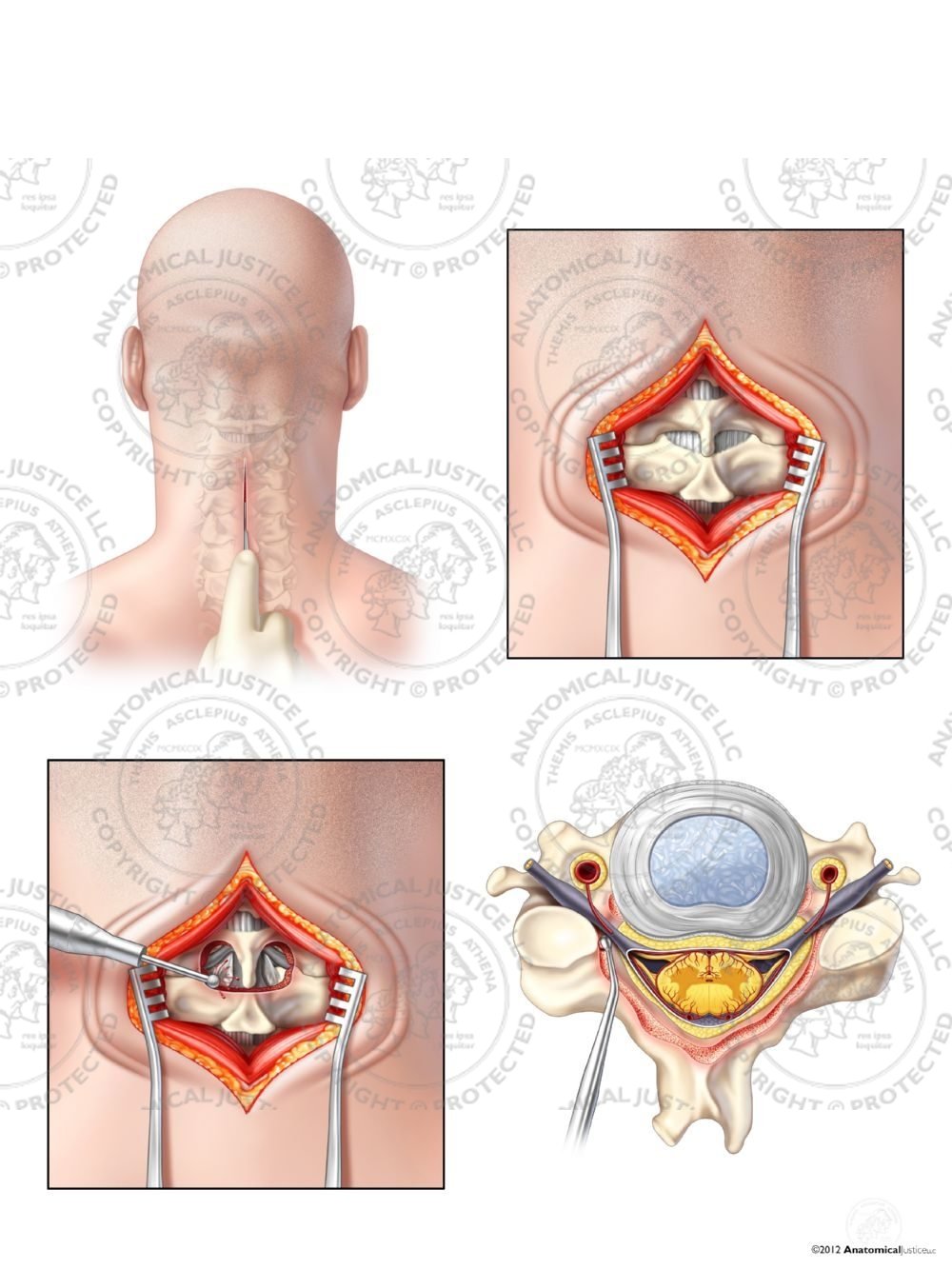 C3-4 Posterior Cervical Hemilaminectomy with Bilateral Foraminotomies – No Text