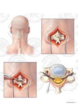 C4-5 Posterior Cervical Hemilaminectomy with Bilateral Foraminotomies – No Text