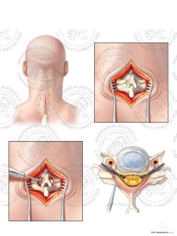 C5-6 Posterior Cervical Hemilaminectomy with Bilateral Foraminotomies – No Text