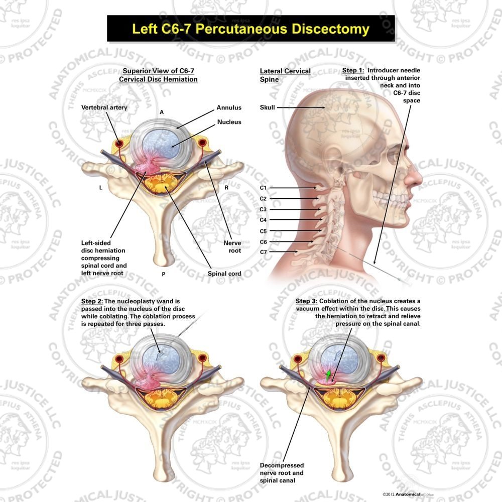 Male Left C6-7 Percutaneous Discectomy