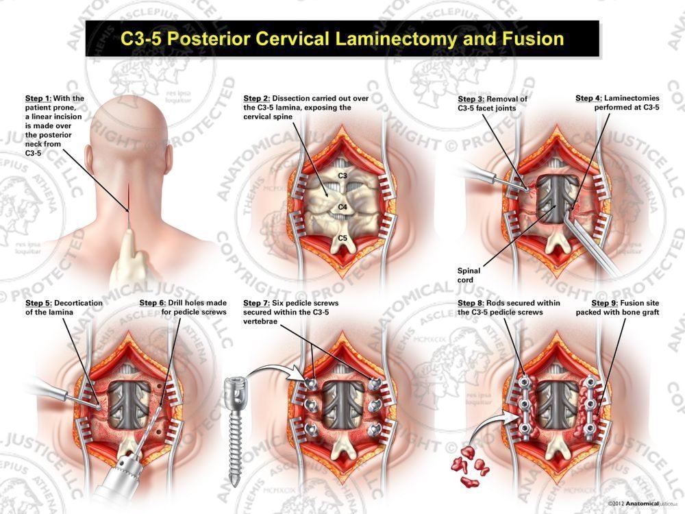 C3-5 Posterior Cervical Laminectomy and Fusion