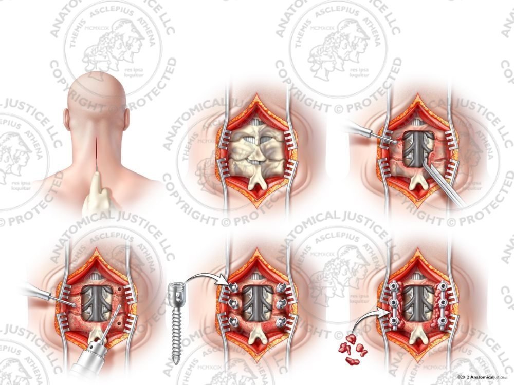 C3-5 Posterior Cervical Laminectomy and Fusion – No Text