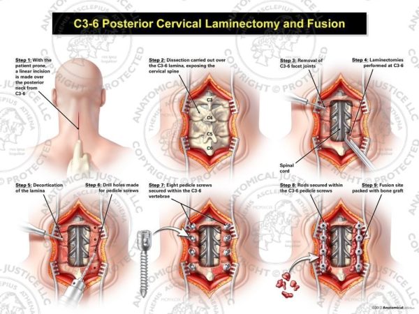 C3 6 Posterior Cervical Laminectomy And Fusion 6673