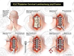 C3-7 Posterior Cervical Laminectomy and Fusion