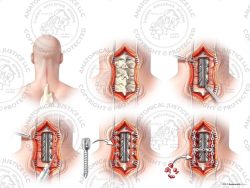 C3-7 Posterior Cervical Laminectomy and Fusion – No Text