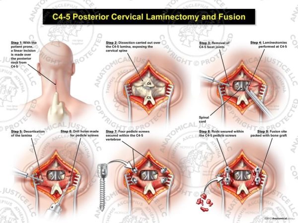 C4 5 Posterior Cervical Laminectomy And Fusion 0832