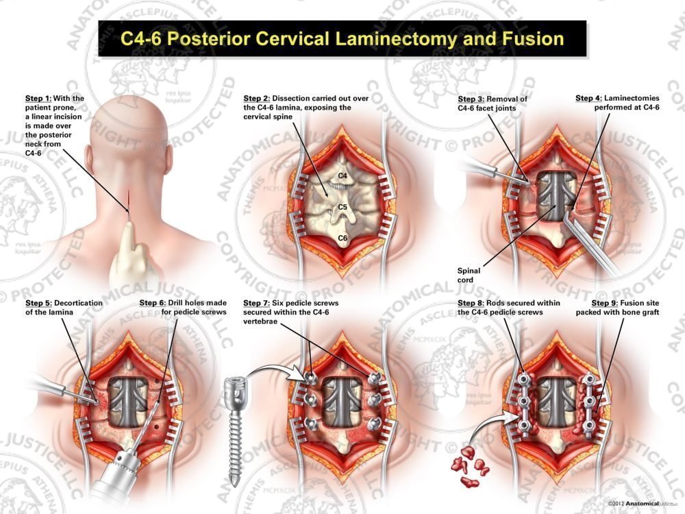 C4-6 Posterior Cervical Laminectomy and Fusion
