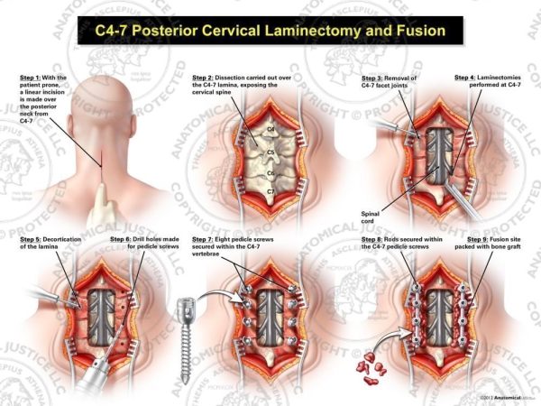 Posterior Cervical Laminectomy