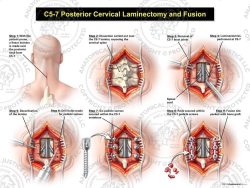 C5-7 Posterior Cervical Laminectomy and Fusion