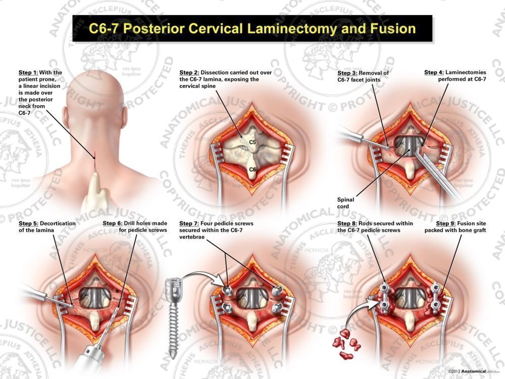 C6-7 Posterior Cervical Laminectomy and Fusion