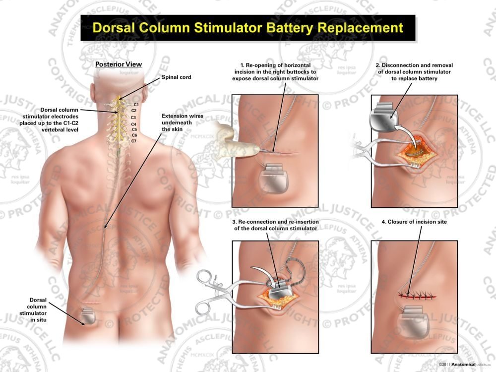 Male Left Cervical Dorsal Column Stimulator Battery Replacement