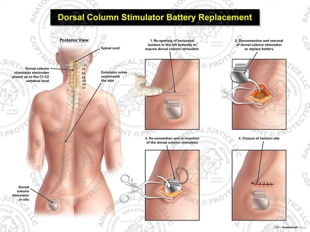 Female Left Cervical Dorsal Column Stimulator Battery Replacement