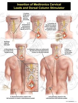 Male Left Dorsal Column Stimulator Insertion
