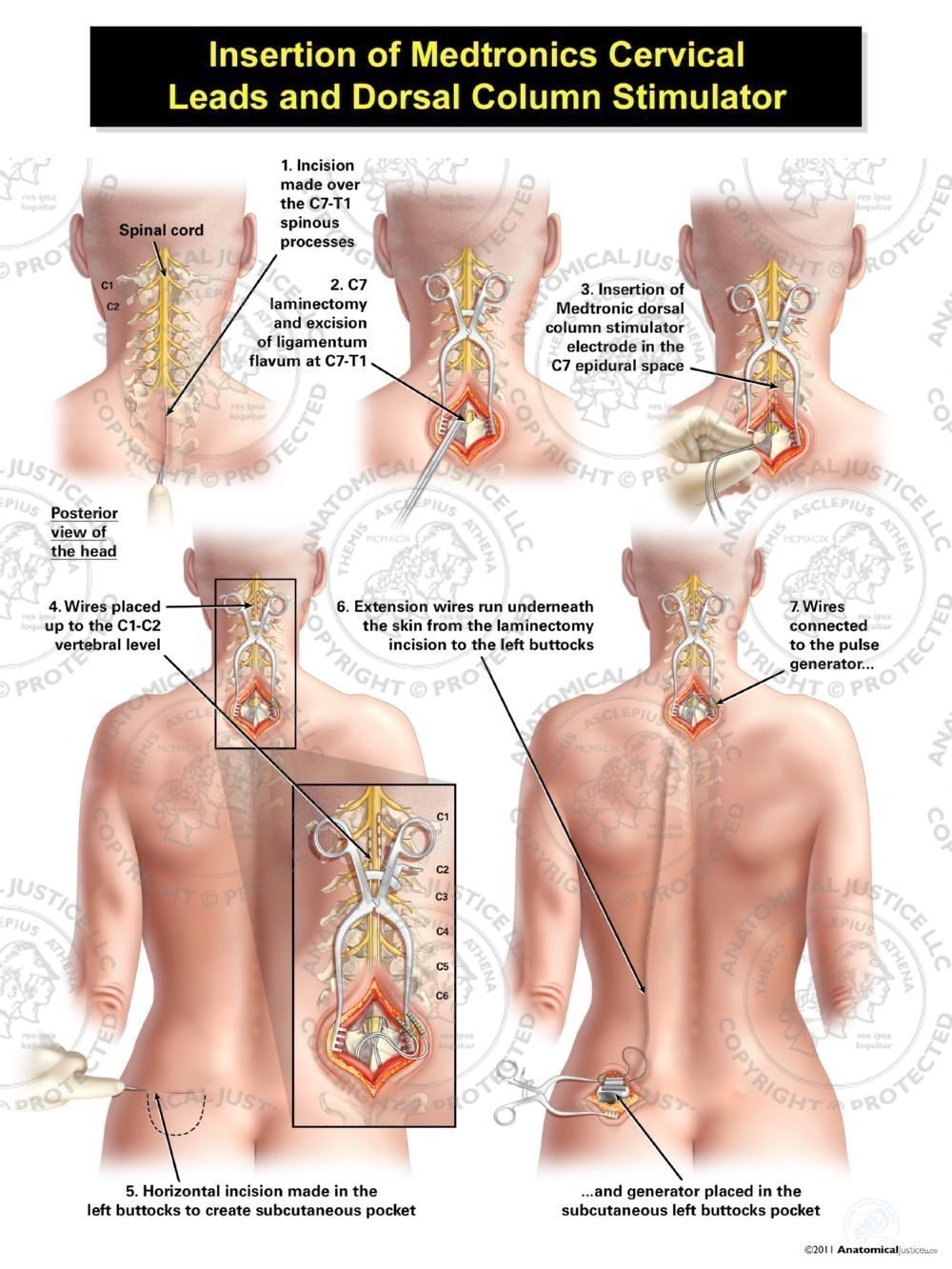 Female Left Dorsal Column Stimulator Insertion