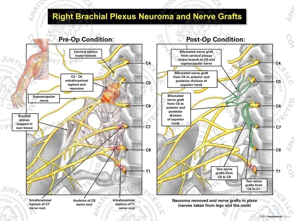 Right Brachial Plexus Neuroma and Nerve Grafts