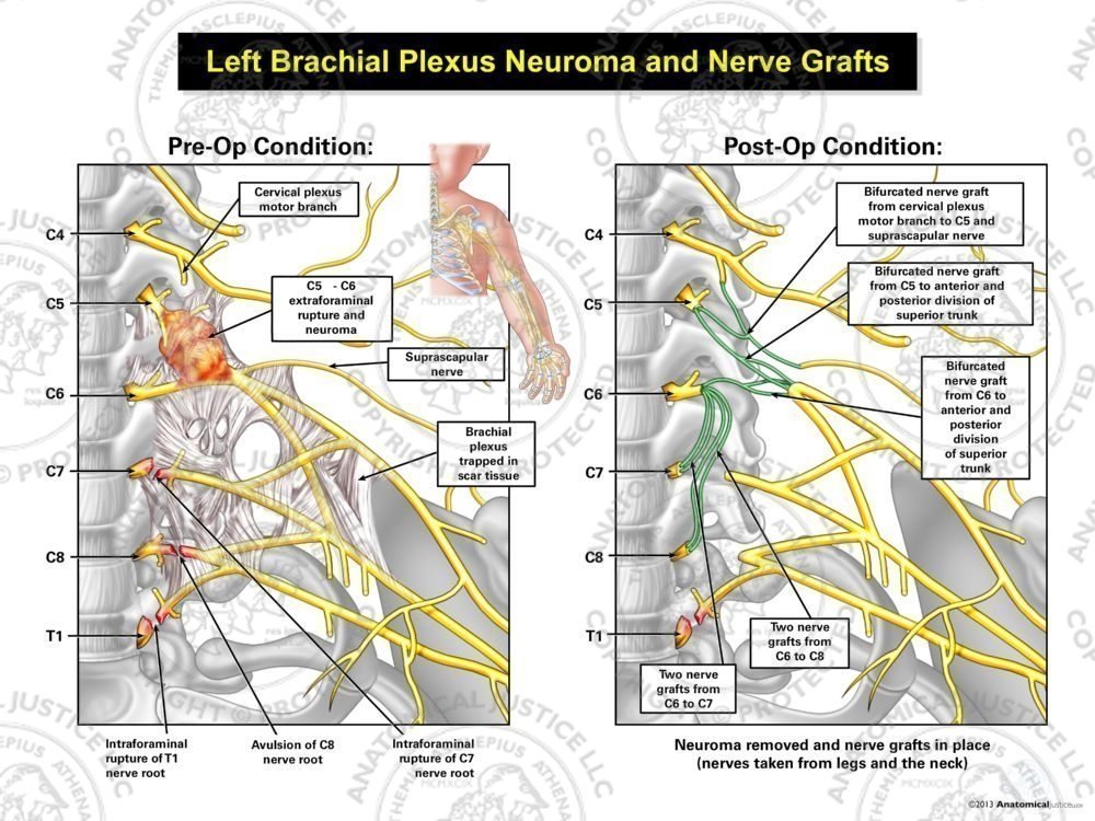 Left Brachial Plexus Neuroma and Nerve Grafts