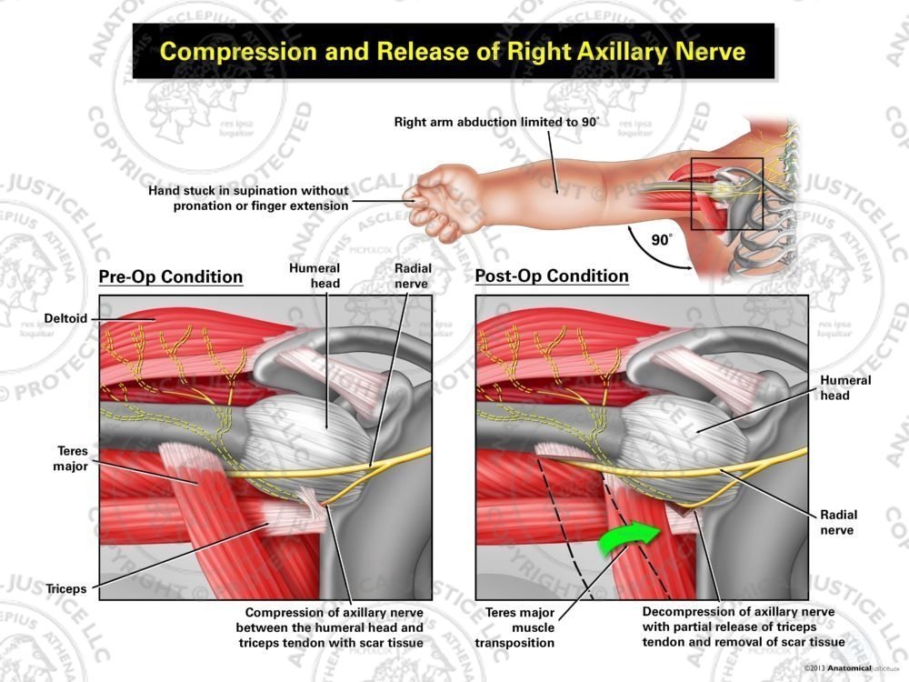 Compression and Release of the Right Axillary Nerve