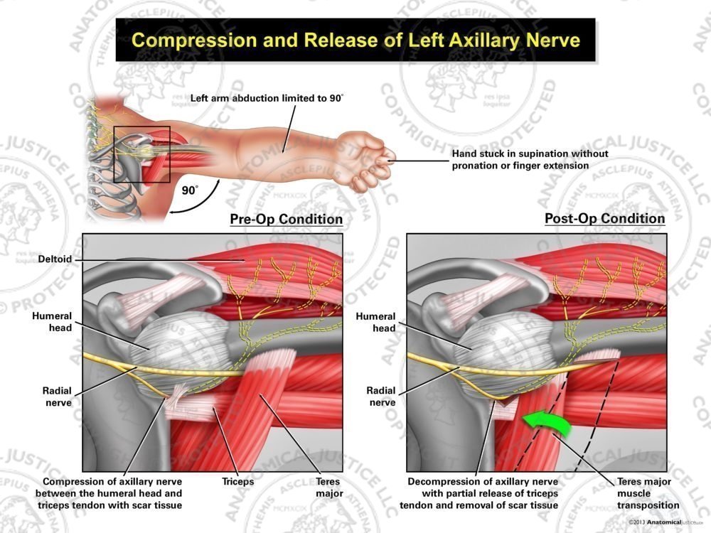 Compression and Release of the Left Axillary Nerve