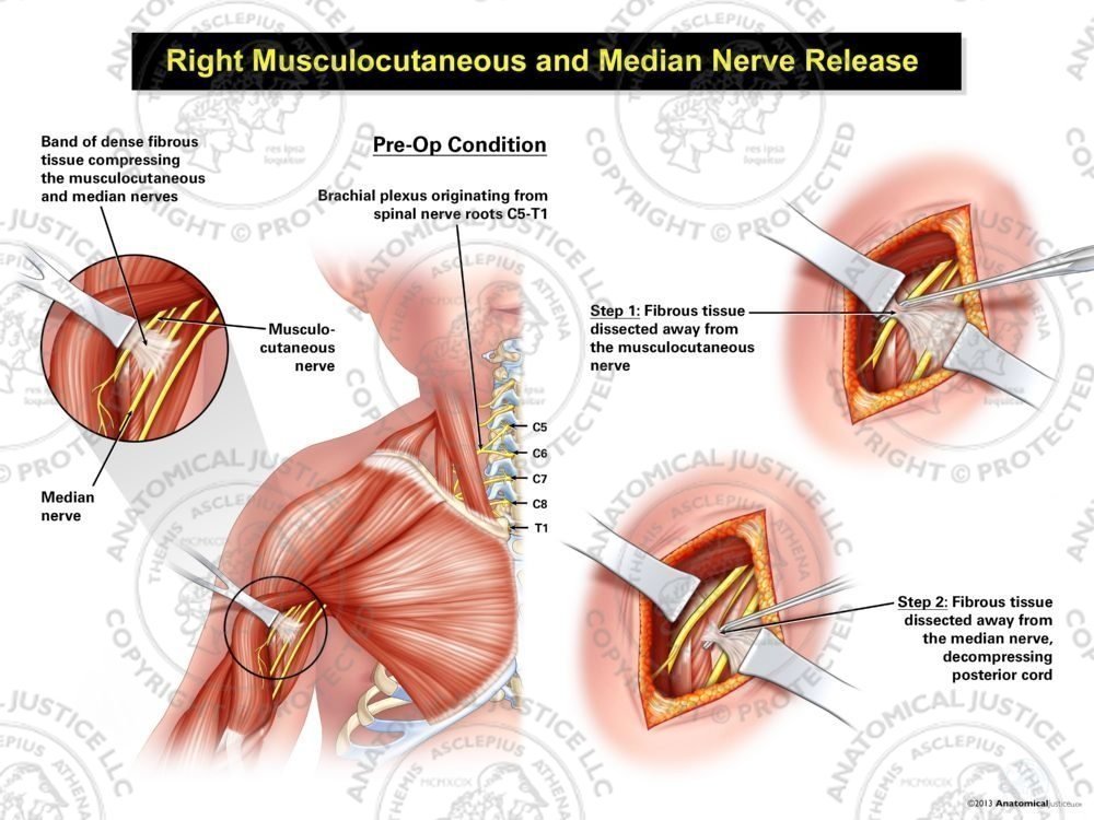 Right Musculocutaneous and Median Nerve Release