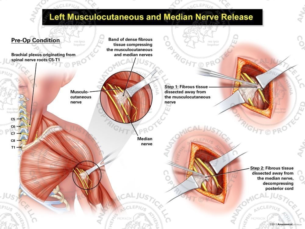 Left Musculocutaneous and Median Nerve Release