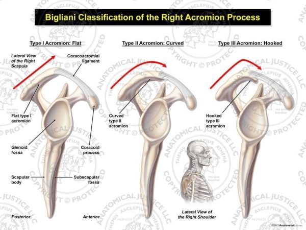 Bigliani Classification of the Right Acromion Process