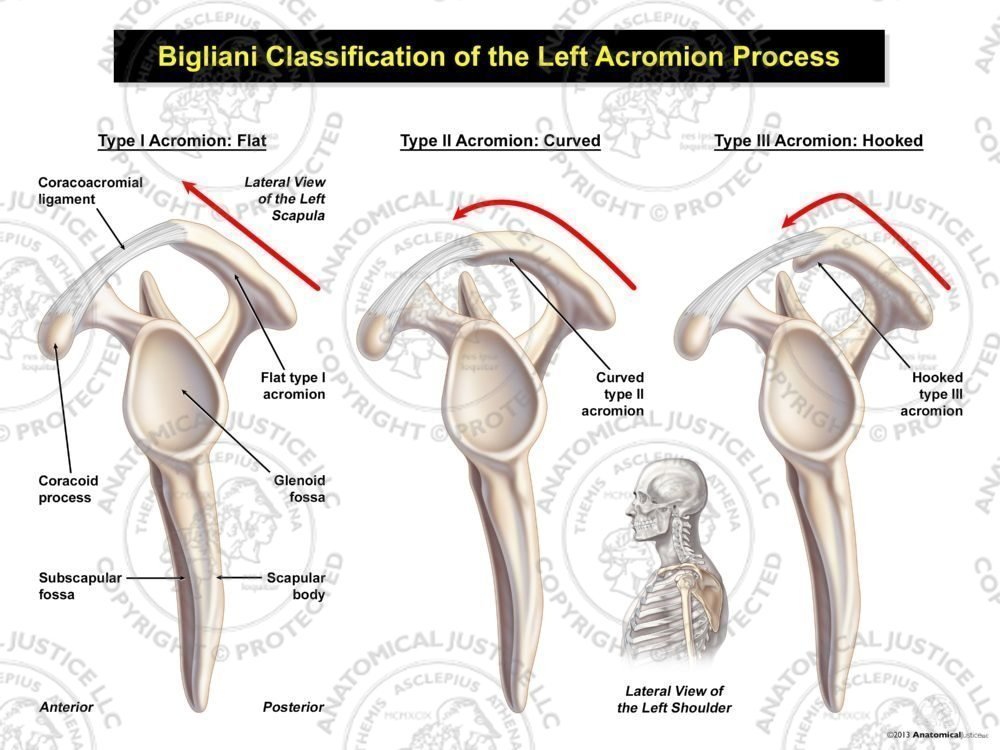 Bigliani Classification of the Left Acromion Process
