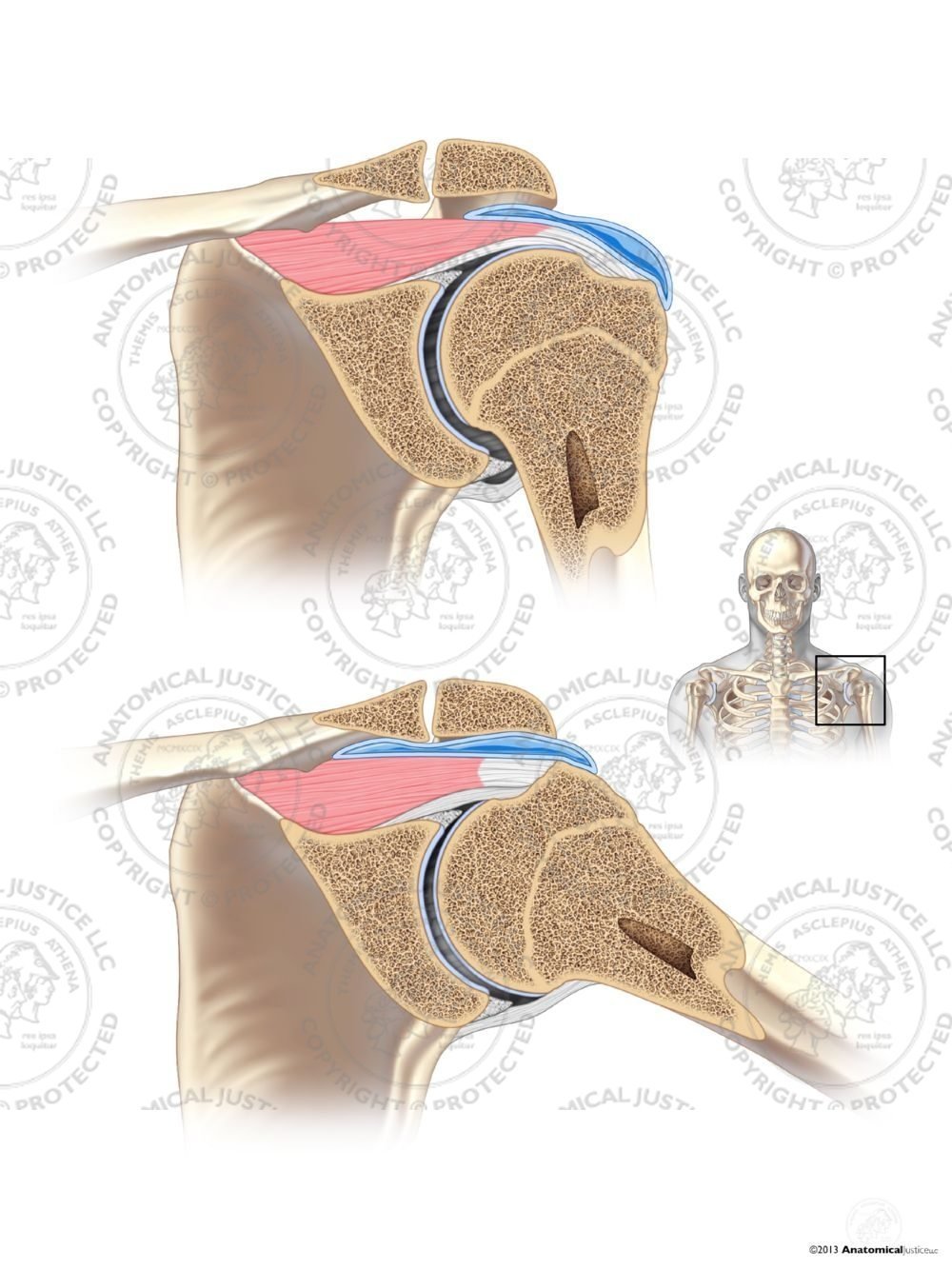 Left Coronal Glenohumeral Joint – No Text