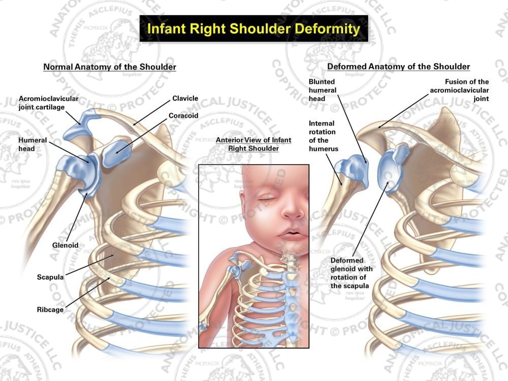 Infant Right Shoulder Deformity