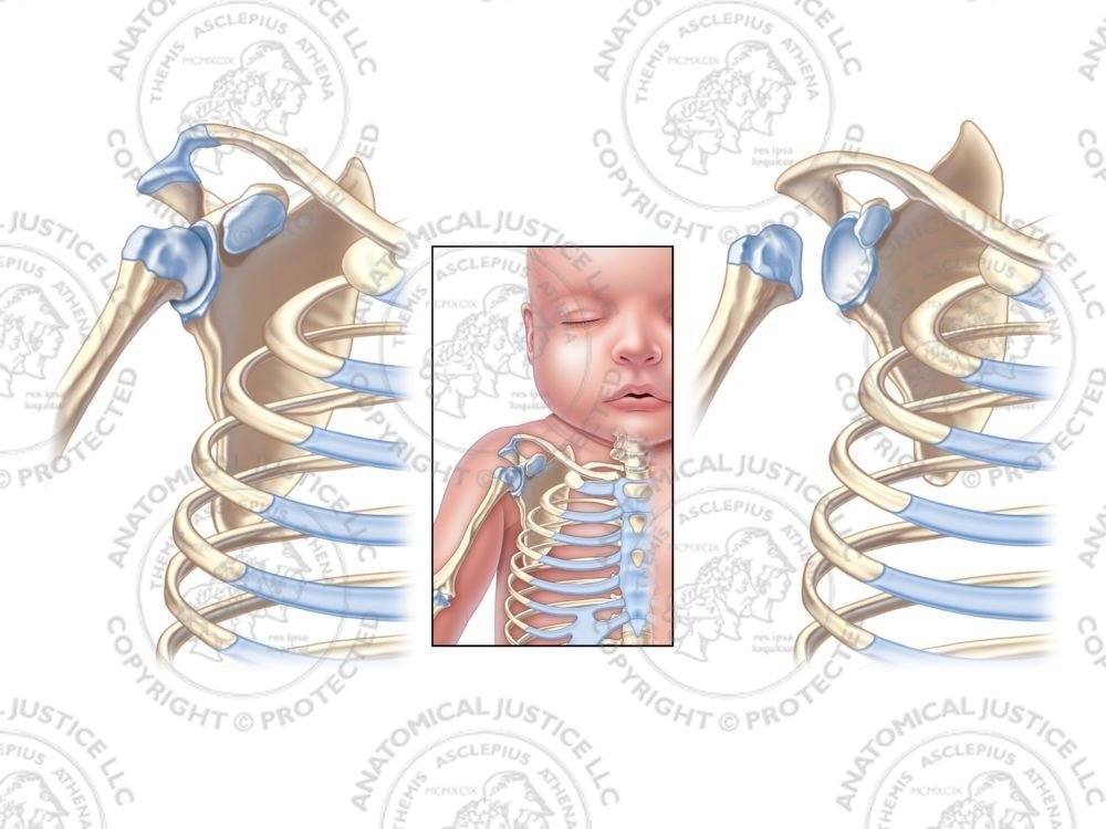 Infant Right Shoulder Deformity – No Text