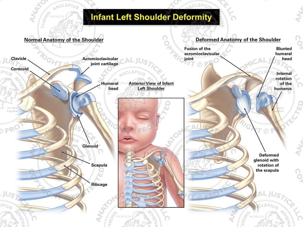Infant Left Shoulder Deformity